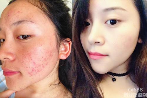脸上有痘痘如何内调外养？痘痘肌护肤技巧