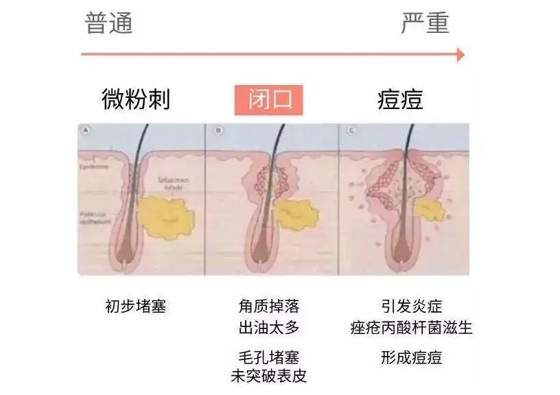 闭口是怎么产生的？闭口应该怎么去除？